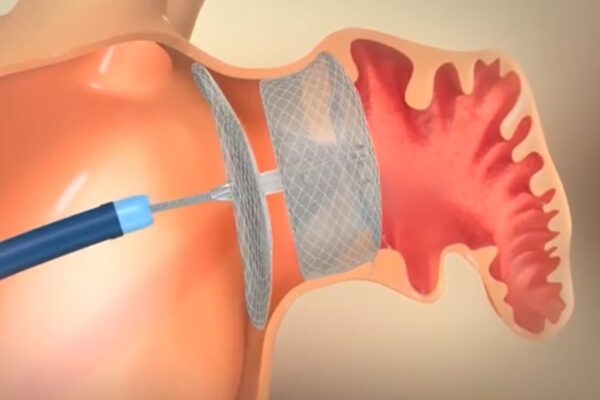  cierre de orejuela watchman