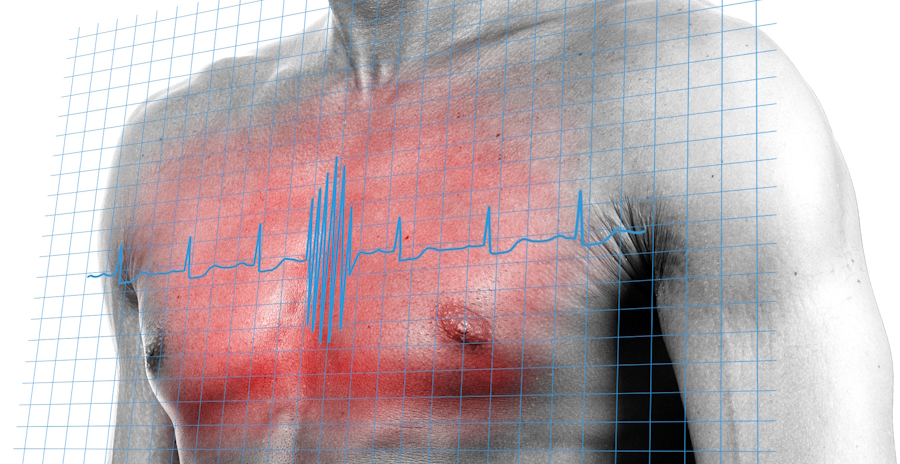  cierre de orejuela cardiaca