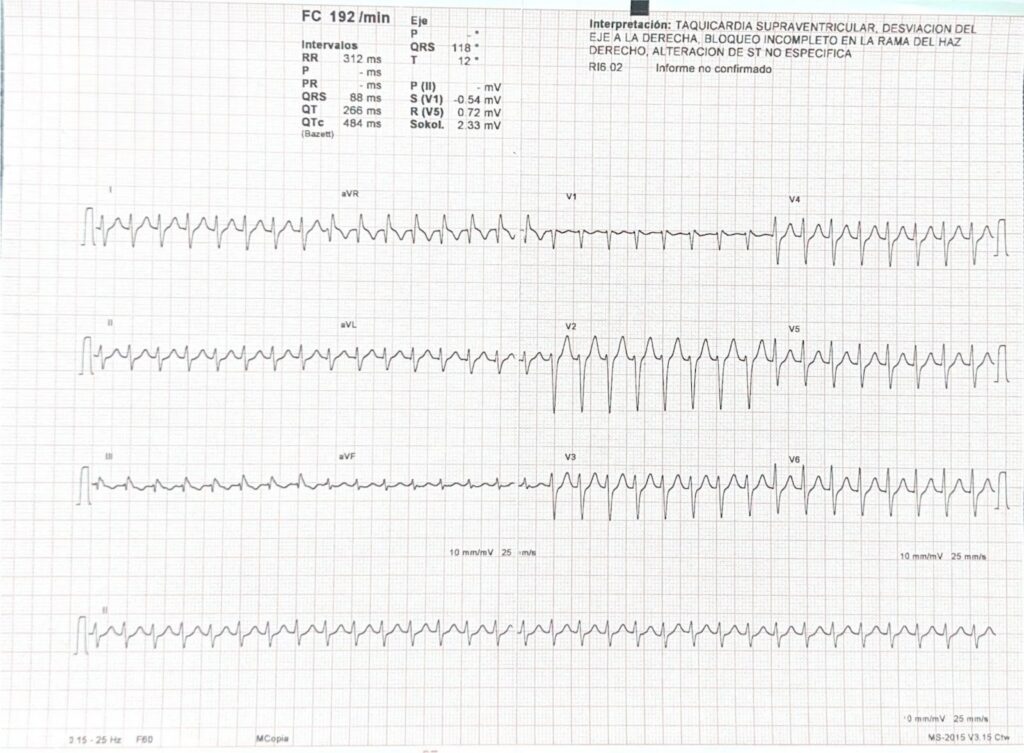 Electrocardiograma real mostrando un ritmo rápido y regular compatible con Taquicardia Supraventricular (TSV), con frecuencia aproximada de 190 latidos por minuto.