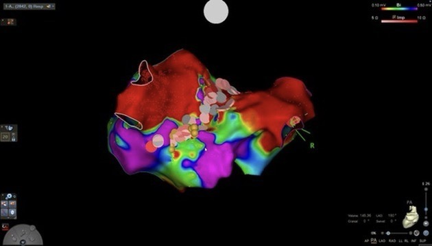 Mapa electroanatómico del corazón utilizado para ablación de fibrilación auricular