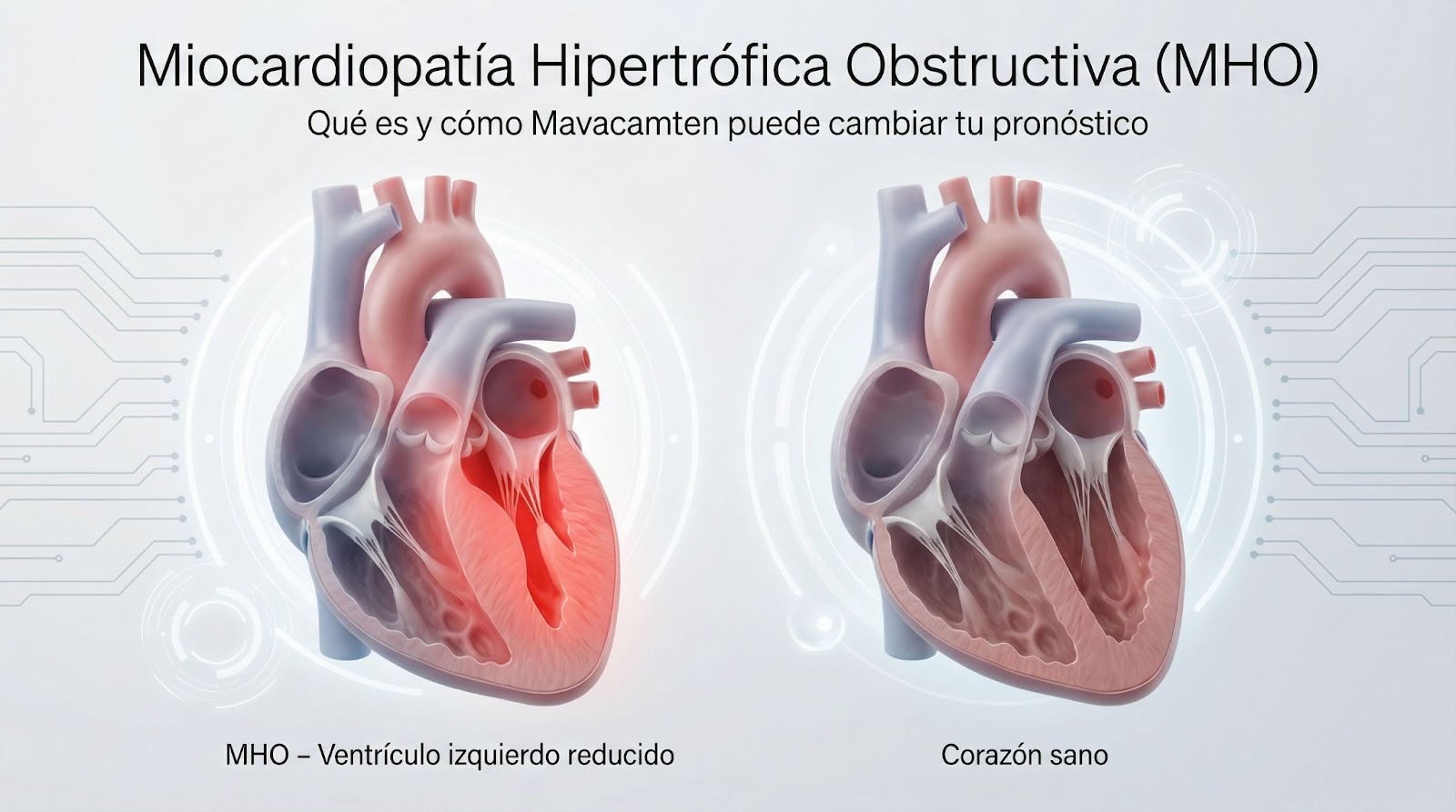 Ilustración médica 3D de miocardiopatía hipertrófica obstructiva mostrando el ventrículo izquierdo engrosado comparado con un corazón sano, tratamiento innovador con Mavacamten.