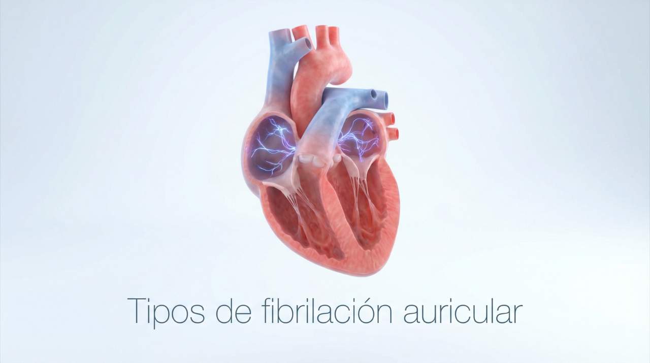 Ilustración de corazón con actividad eléctrica irregular representando la fibrilación auricular. Material educativo respaldado por el Dr. Nicolás Reyes Reyes, cardiólogo electrofisiólogo y referente regional en el manejo de fibrilación auricular en Puebla. Cardiac & Vascular Center.