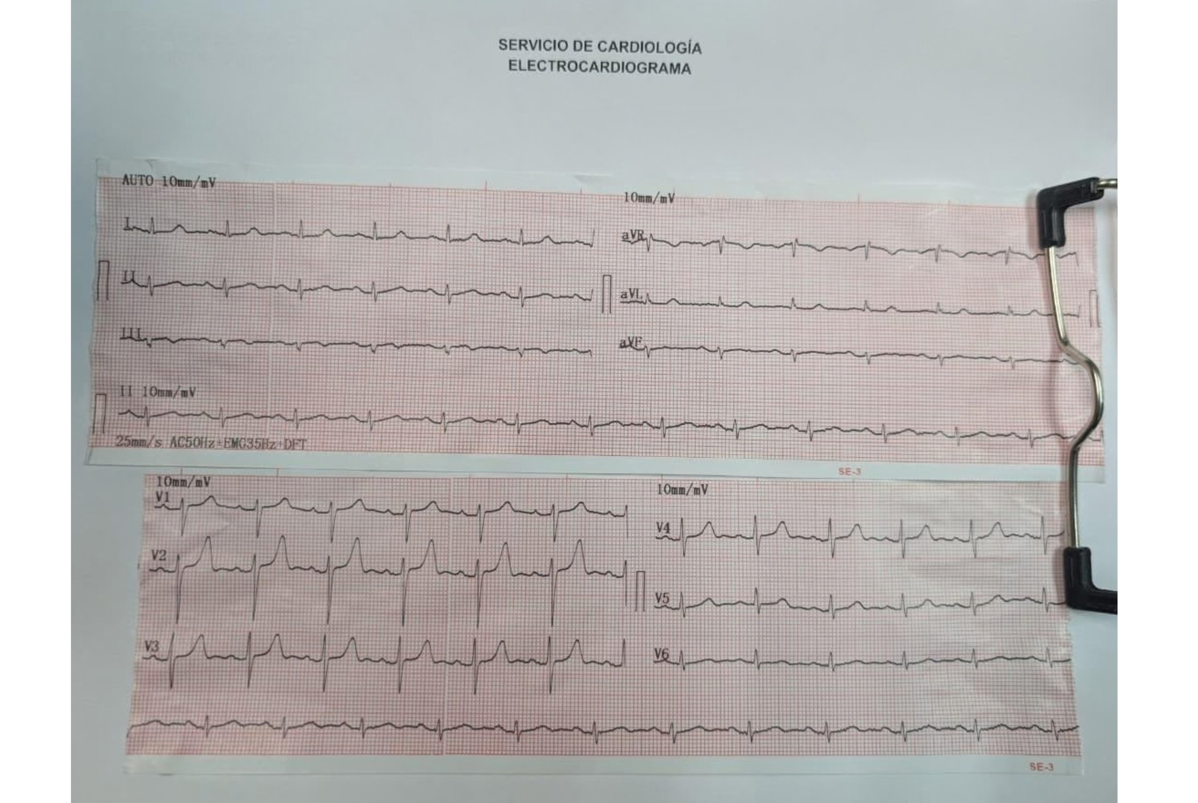 Electrocardiograma real de Alberto, paciente del Dr. Nicolás Reyes, con flutter auricular y síndrome de Wolff-Parkinson-White.