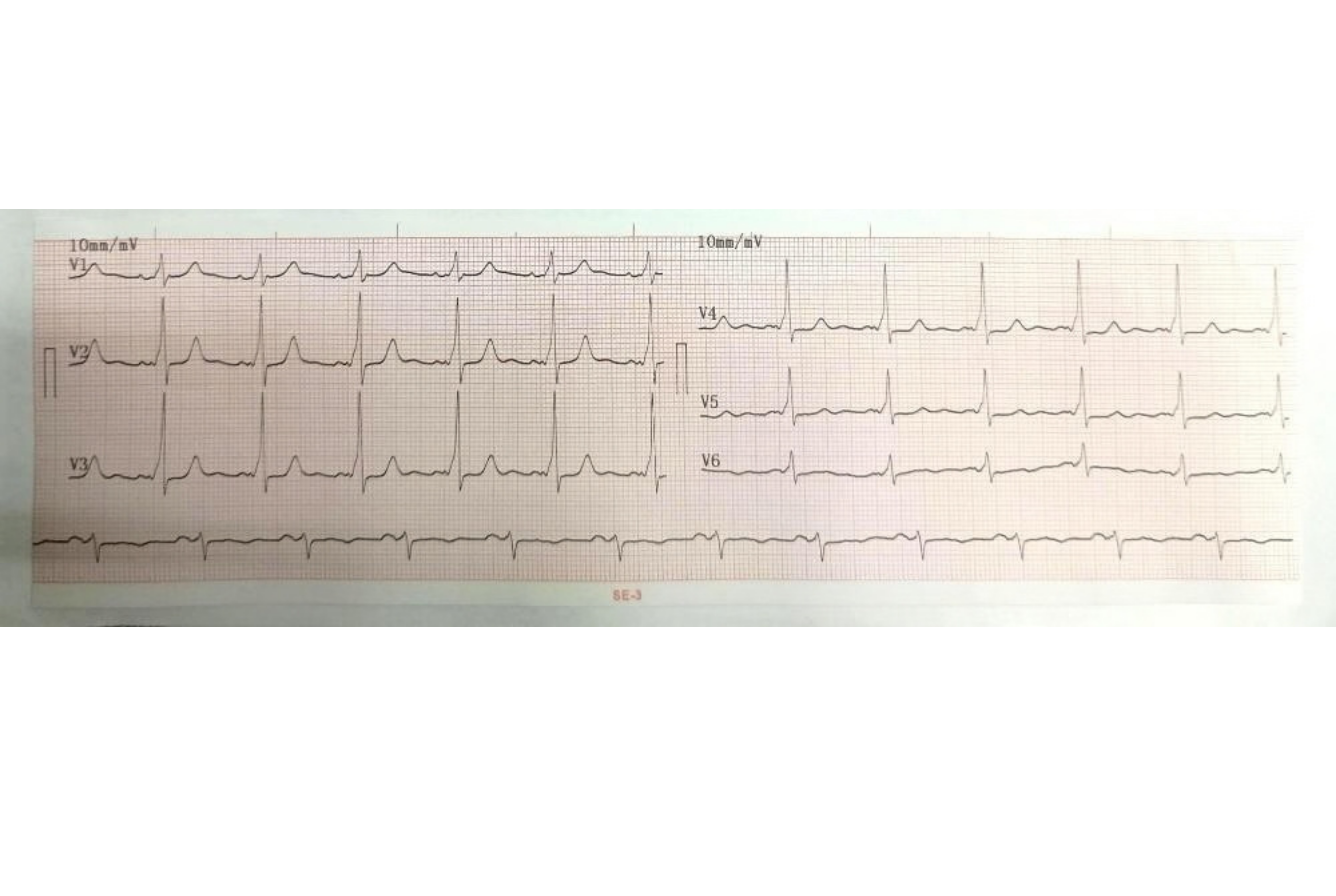 Electrocardiograma con patrón de preexcitación por vía accesoria, similar al que puede confundirse con una arritmia ventricular grave.