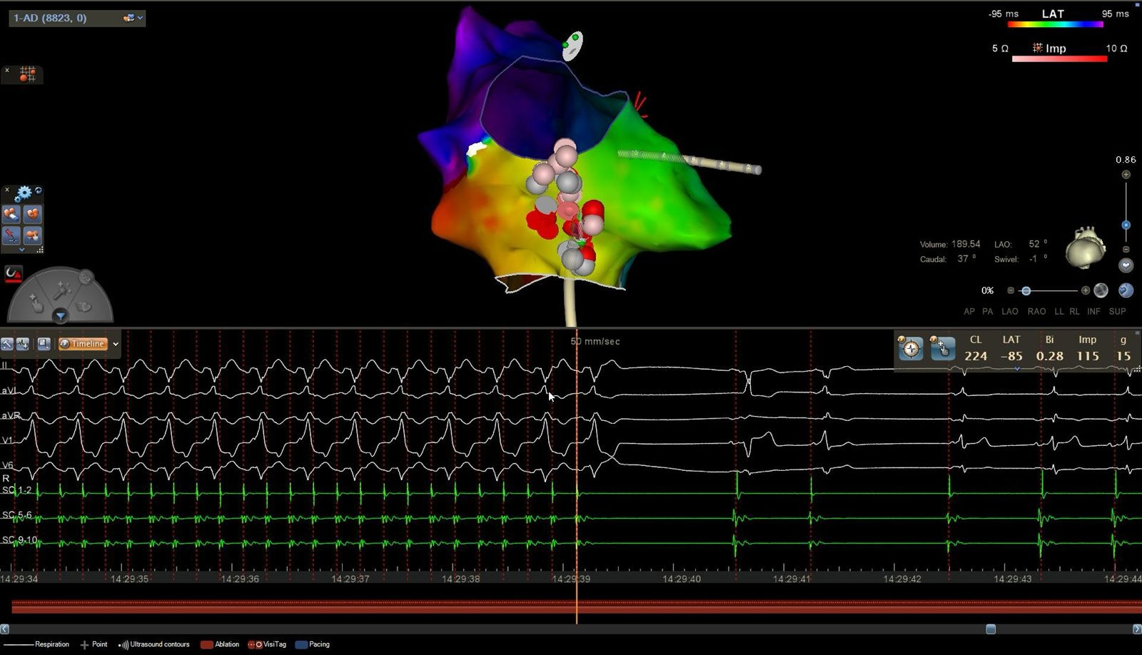 Mapeo electroanatómico del corazón (CARTO) usado durante una ablación por catéter de flutter auricular y Wolff-Parkinson-White.