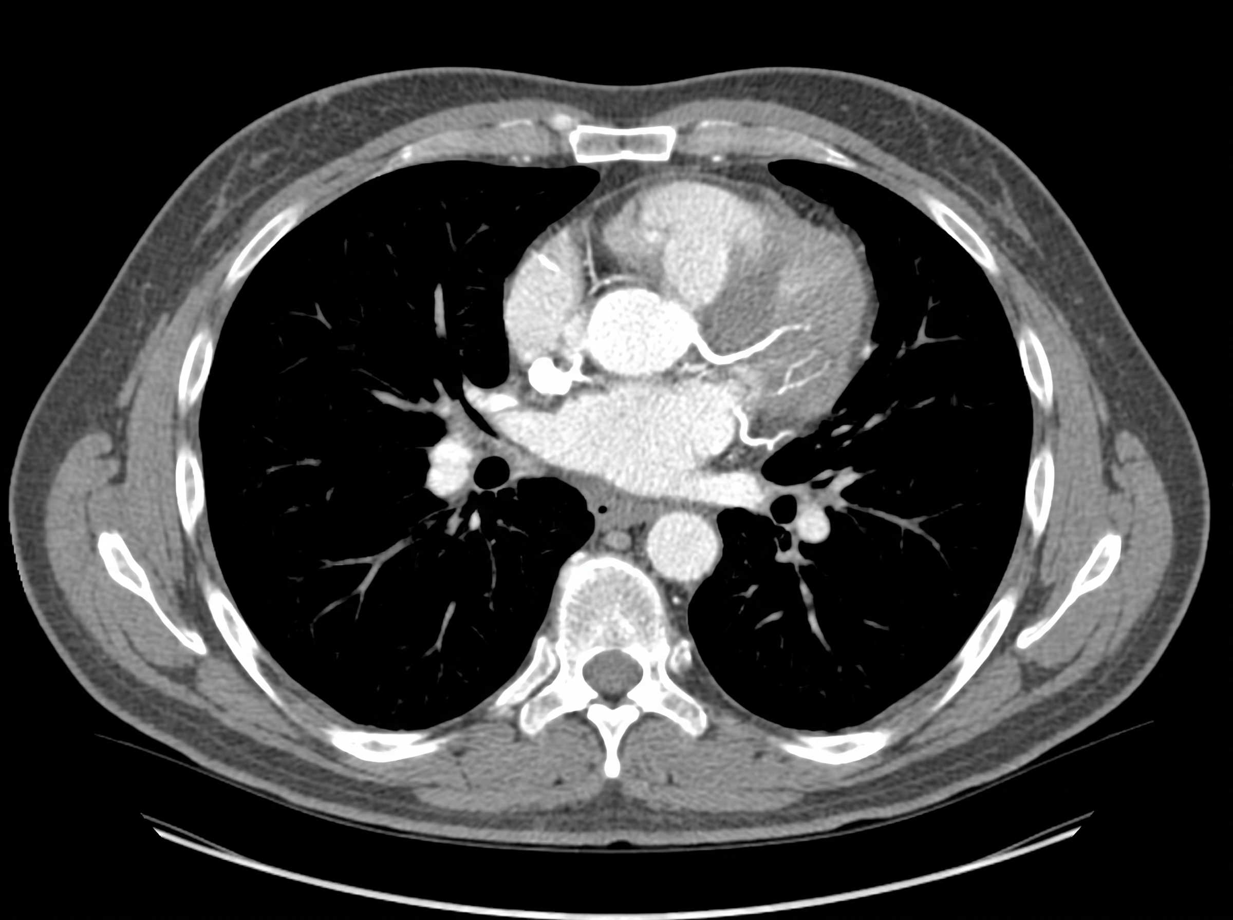 Corte axial de tomografía de tórax con contraste que muestra el corazón y las arterias coronarias en una angiotomografía